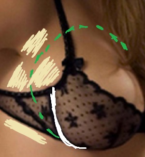 Bra wire digging into the breast root