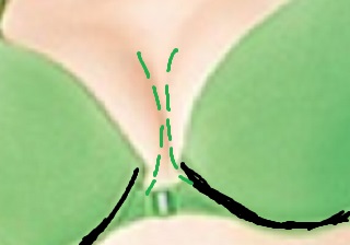 Unnatural cleavage