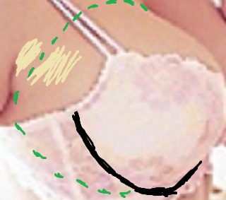 Wide breast root with too small bra